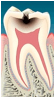 次の段階では、エナメル質より軟らかい象牙質まで虫歯が進行してしまうと冷たい水が歯にしみ始めます。