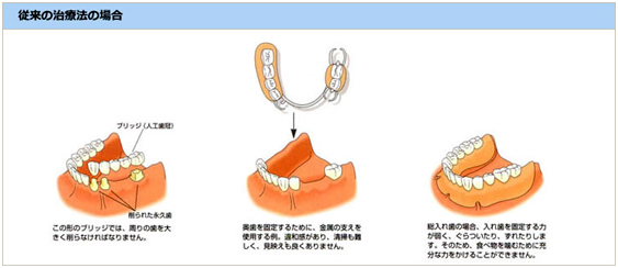 インプラント治療の場合