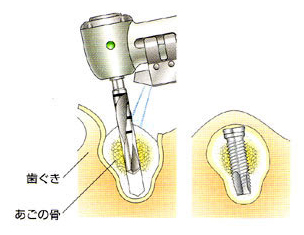 一次手術