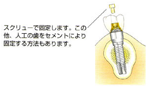 人工の歯を作製・装着