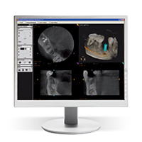 歯科用ＣＴ