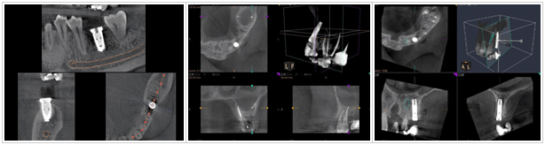 CTスキャンとインプラント治療