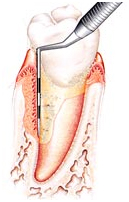 歯周病治療